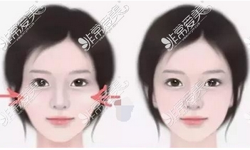 颧骨整形失败案例怎么样？颧骨整形需慎重，挑选整形医院也很重要！