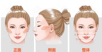 颧骨整形失败案例怎么样？颧骨整形需慎重，挑选整形医院也很重要！