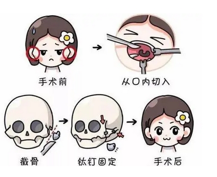 江苏颧骨内推专家谁好?崔磊、张东辉、吴国平等五位医生等你了解!