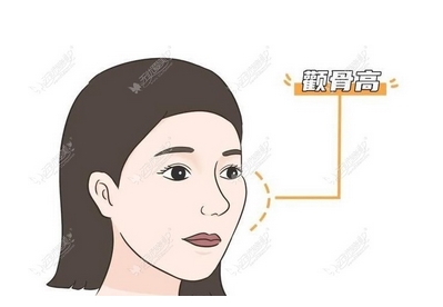 江苏颧骨内推专家谁好?崔磊、张东辉、吴国平等五位医生等你了解!