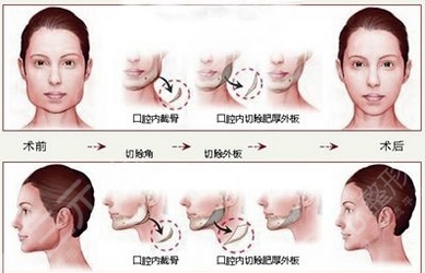合肥磨骨专家排名前十有哪些？在磨骨医生排行榜上的不踩雷！看看有谁你认识~