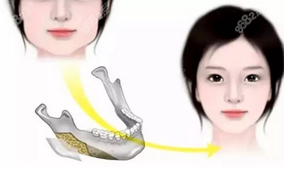南京做下颌角医生谁比较好?谁的综合实力稳居第一位!专家实力PK~