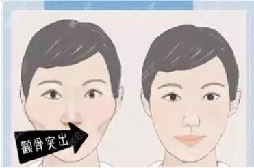 福建颧骨内推公立医院排名公布!各家优势技术都不同,实力过硬!