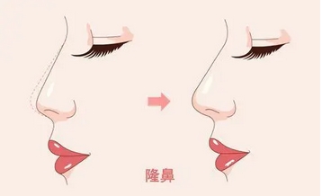 绍兴鼻修复好的医生有哪些?排名榜单医生公布!方长亮医生锁定前三~
