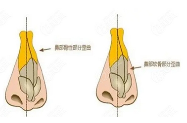 惠州鼻修复好的医生有哪些?洪小芳、曹兴慧、陈虹等,实力不容小觑!