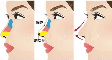 南昌做鼻子好的医生有哪些？1分钟读完的隆鼻攻略,姐妹们赶紧看！