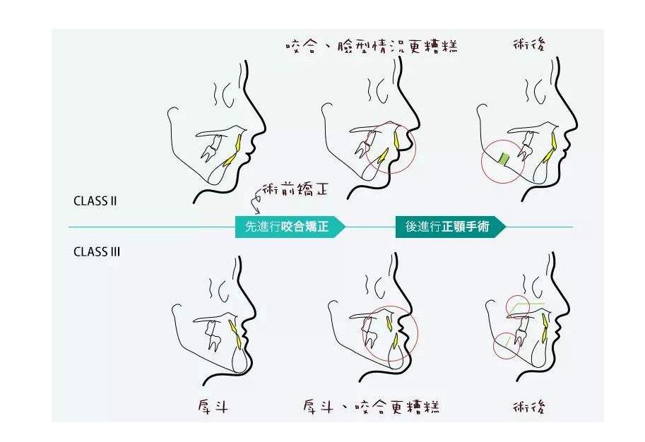 四川友谊医院磨骨多少钱?费用价格-赵延峰、李继华医生简介-案例参考