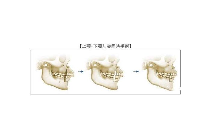 四川友谊医院磨骨多少钱?费用价格-赵延峰、李继华医生简介-案例参考