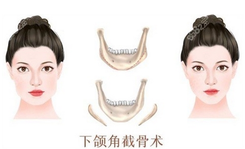 无锡哪家医院可以做下颌角?排名前五位整形美容医院详情一览!看哪些医院入围了~