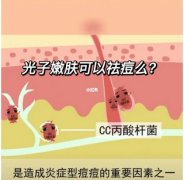 光子对痤疮的作用原理怎么样？找到源头是关键，教你怎么做可以减少痤疮问题！