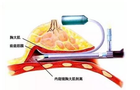 北京八大处刘春军怎么样？医生简介_隆胸真实案例分享！戳我get~