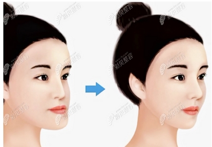 偏颌矫正的方法有哪些？方法过程&手术注意事项讲解！要你自信又美丽！