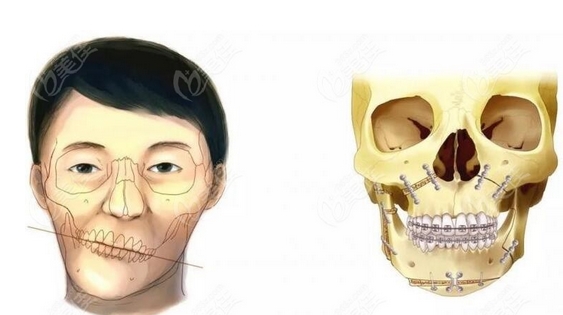 偏颌矫正的方法有哪些？方法过程&手术注意事项讲解！要你自信又美丽！