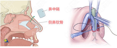 叶信海做鼻子好吗？医生资料介绍/技术优势分析/隆鼻必修课！