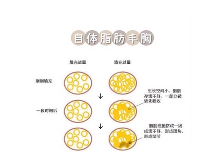 自体脂肪丰胸安全可靠吗？具有哪些优势及存在哪些禁忌症？都带你了解~