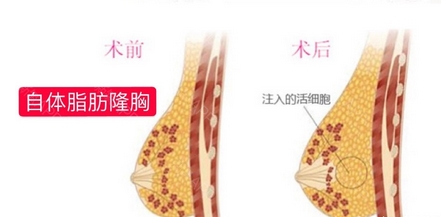 自体脂肪丰胸安全可靠吗？具有哪些优势及存在哪些禁忌症？都带你了解~