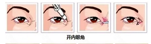 张冰洁修复内眼角案例如何？开眼角大小修复案例~帮您解除各种疑虑！