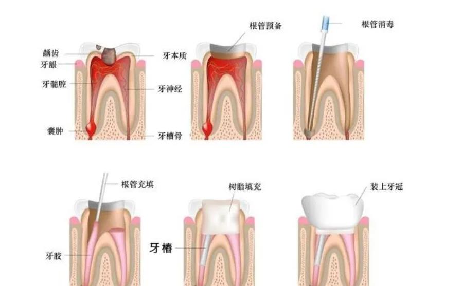 湘雅医院牙科哪个医生好一点？口腔内科方厂云简介_根管调节案例