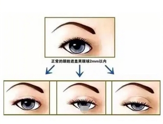 北京八大处李芯双眼皮怎么样呢？手术原理深度了解！附术后反馈测评分享~