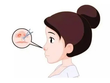 福州海峡整形美容医院怎么样？想要隆鼻更快自然，这篇科普得熟读！