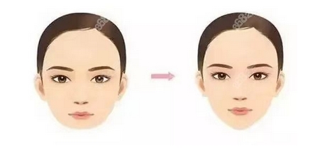 磨骨瘦脸手术多少钱?口碑评价反馈_磨骨瘦脸果展示!
