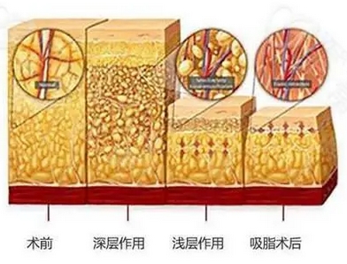 宋延刚吸脂评价如何？医生技术实力剖析，美体塑形案例曝光！