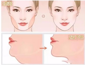 双下巴吸脂多少钱?术前准备工作有哪些?附注意事项~