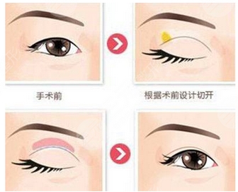 苏薇洁修复双眼皮厉害还是余东？医生对比简介_技法风格怎么样？审美杠杠的~