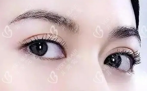 李正勇割双眼皮怎么样？审美风格怎么样？医生技术_案例近期反馈！