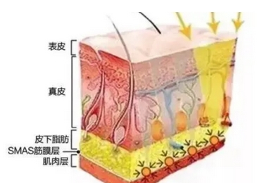 fotona4D和热玛吉的区别有哪些？原理及操作方法都有区别！本文带你探究~