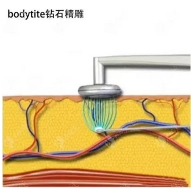 钻石精雕吸脂恢复期多久?钻石精雕技术实力剖析,美体塑形信息曝光!