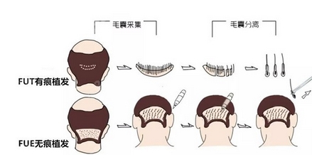 成都恒博头发种植怎么样?三位大咖技术审美优势!附种发案例介绍~