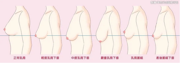 胸部整形前后对比如何?几个阶段分享,带你深入了解术后过程!