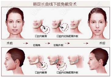 下颌角长曲线截骨术价格如何?果好不好?让你遇到自己的魅力!