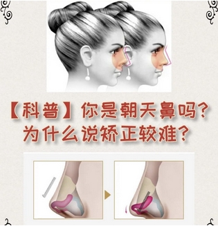 朝天鼻整形案例如何？实力案例全面盘点，“塌鼻星人”别错过！