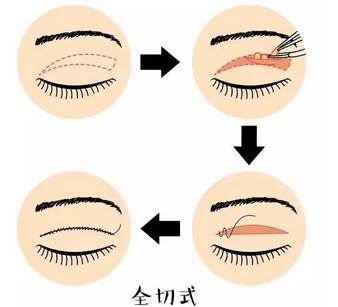 王太玲医生做双眼皮怎么样？教你认识真实术后案例！放大你的双眼~