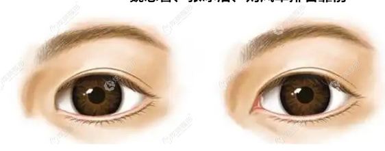 张冰洁眼综合案例怎么样?口碑医生实力如何|案例点评,供你参考!