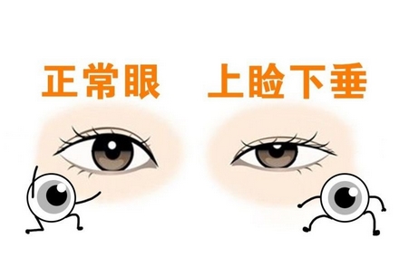 叶信海医生医术怎么样?手术优缺点在线解读!术后半年也在记录!