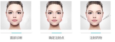 姜陶然瘦脸案例如何？对脸型的改变可能会出乎意料！变小v脸~