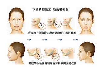 下颌角整形需要多少钱?医院资料-术后注意事项开展~让脸蛋更漂亮自然!
