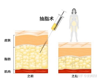 八大处整形医院宋涛怎么样？术后会反弹吗？塑形果怎么样？附医生详细资料~