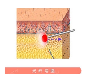 光纤无痕溶脂技术怎么样？溶脂减肥手术过程解析，手术优点深入探查！