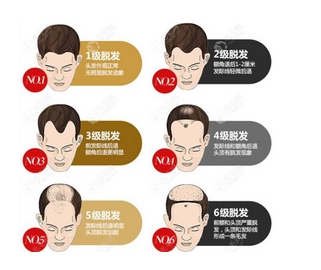 脱发1-7级程度图片怎么样?怎样判断自己是否脱发!含脱发等级判定及恢复方法~