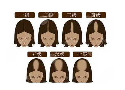 脱发1-7级程度图片怎么样?怎样判断自己是否脱发!含脱发等级判定及恢复方法~