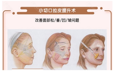 可玫尔医疗美容医院刘美娇小拉皮怎么样？从手术价格及维持时间看果！其他技术特色也很不错~
