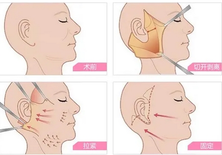 刘美娇医生做拉皮怎么样？这位医生技术好切口隐蔽？重新get“幼态肌”！