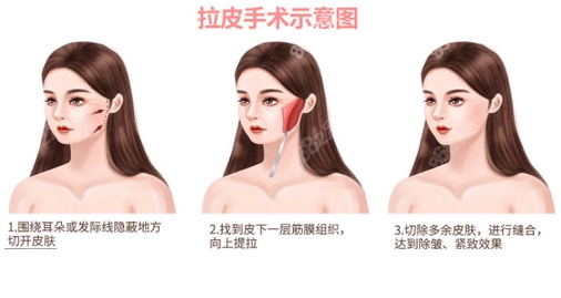 北京王驰做拉皮手术吗?掌握医生医院信息!让肌肤回春的秘笈~