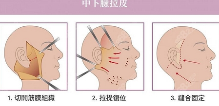 北京华韩高亚东拉皮价格怎么样？本院简介、医生静候光临、手术果查询！