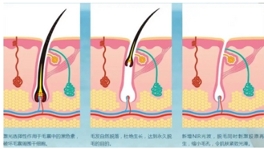 北京口腔医院可以做激光脱毛吗？技术口碑在线你pick谁？附注意事项~