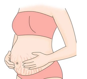 去妊娠纹大概多少钱？这4种方法，可以让妊娠纹恢复了很多！宝妈们的常见苦恼！